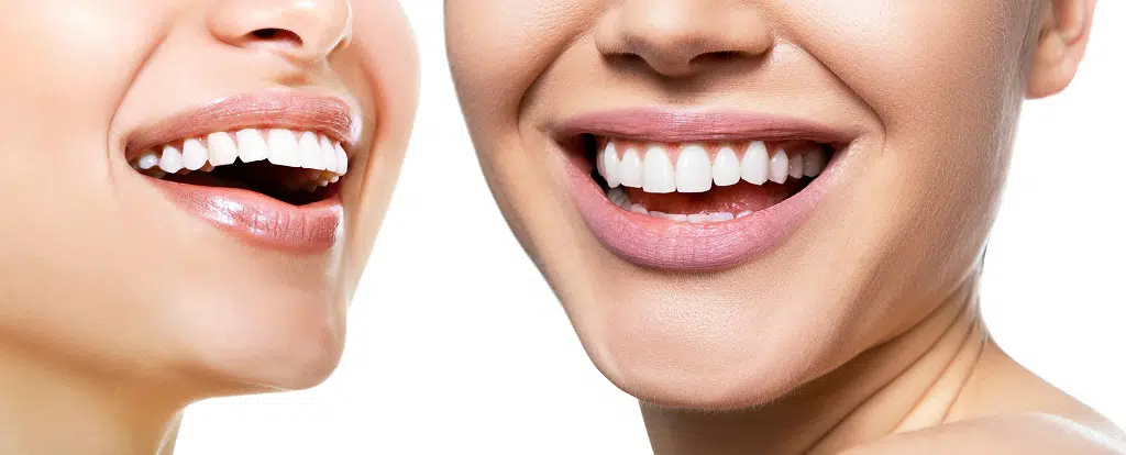 Can Invisalign Widen My Smile?