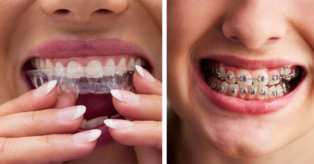 Braces vs Invisalign in Shoreline