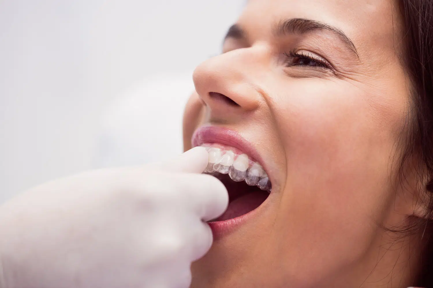 Invisalign In Edmonds, Wa: How To Get The Perfect Smile