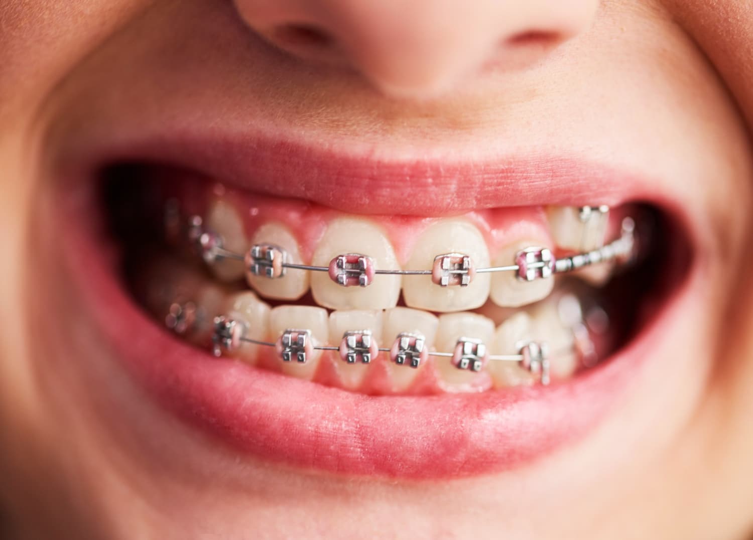 Benefits of Braces