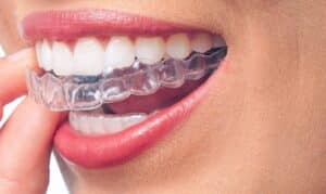 Invisalign Braces for Adults