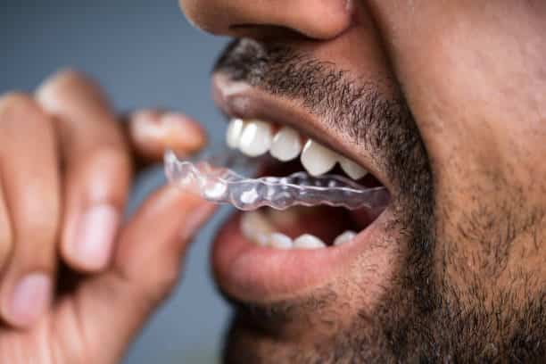 Invisalign Braces for Adults