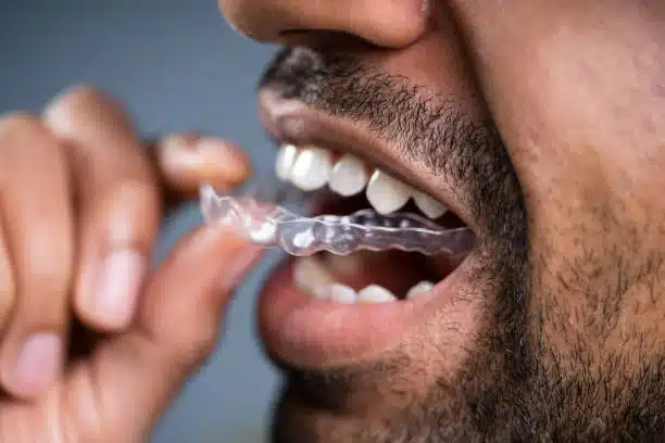 Invisalign Braces For Adults: Everything You Need To Know